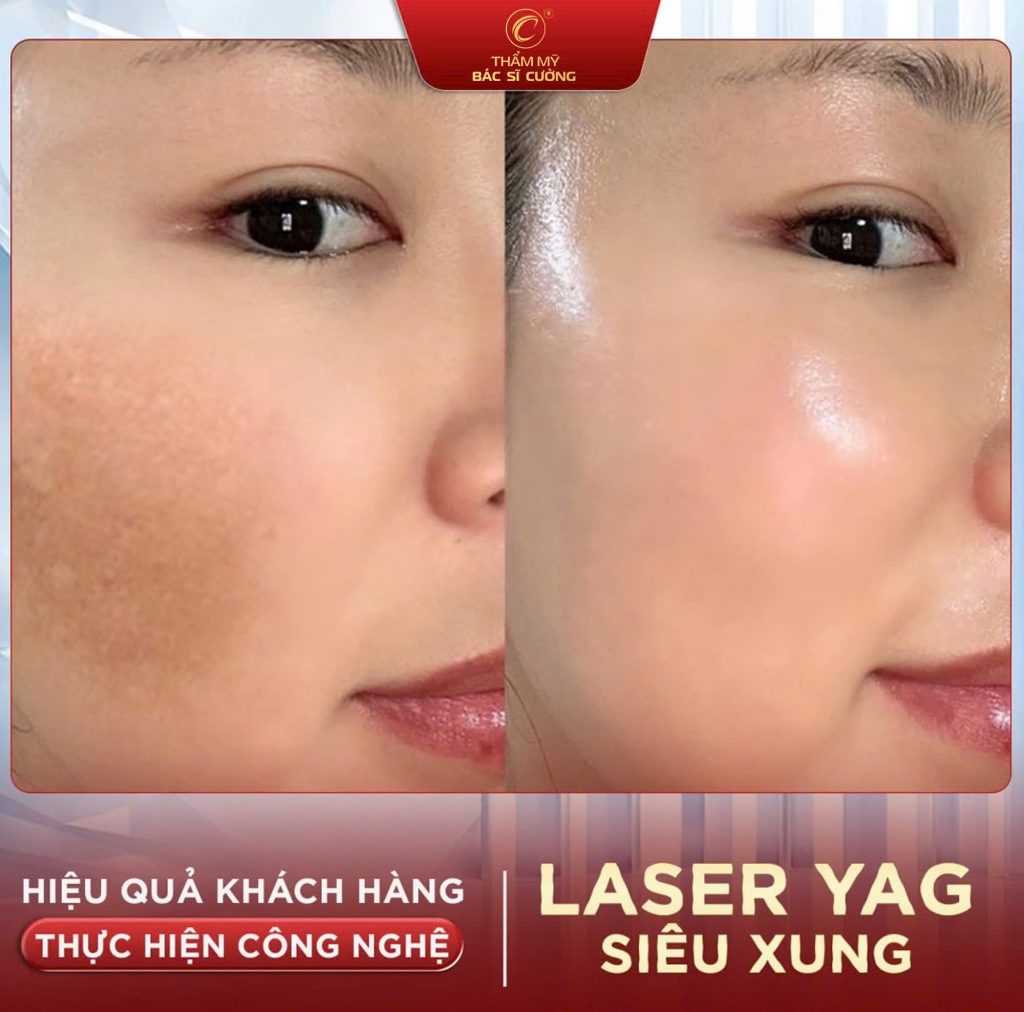 laser