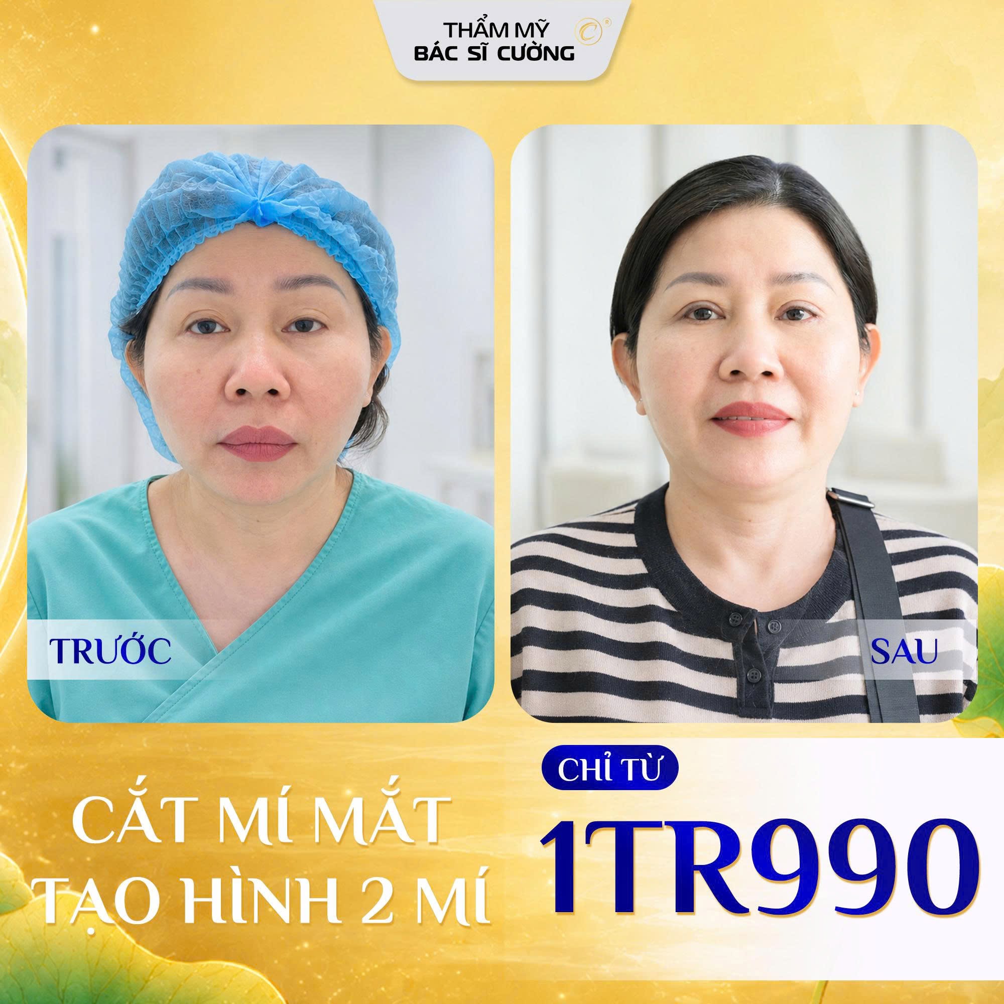 Khách hàng cắt mí mắt tại Thẩm mỹ BS Cường