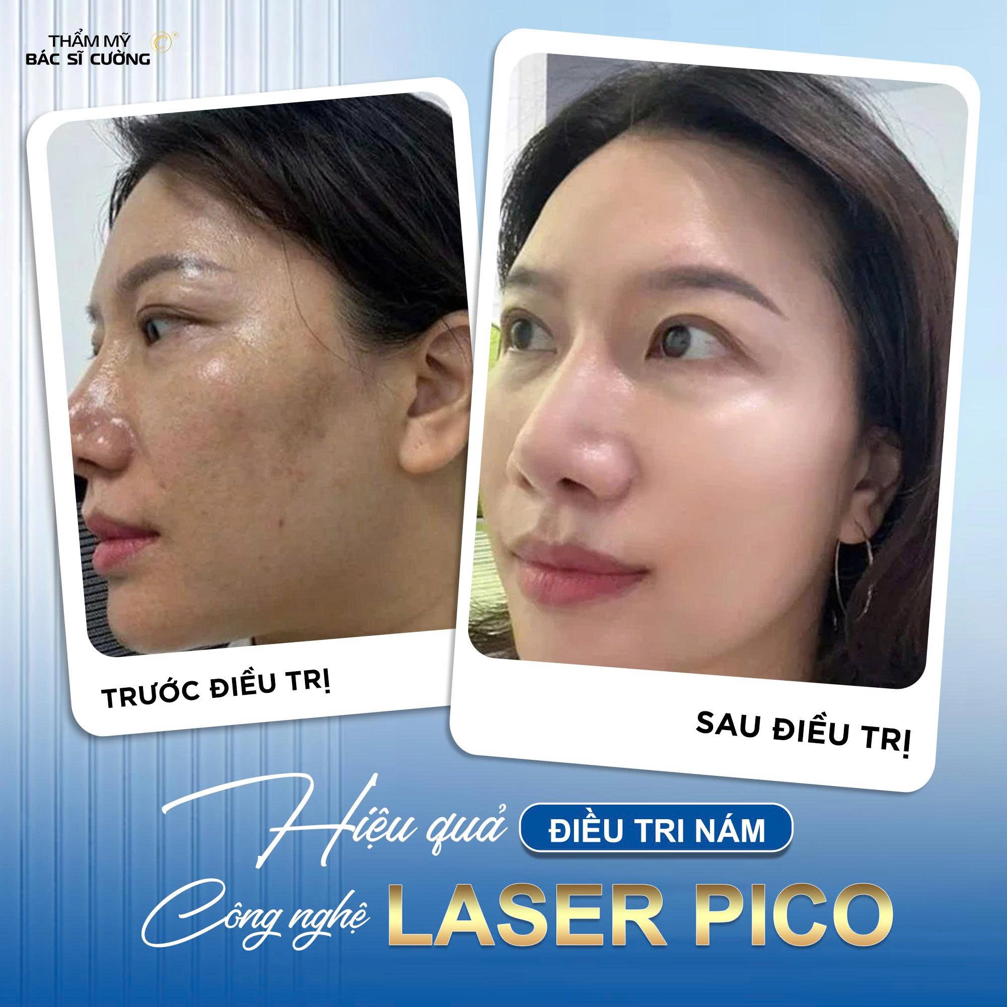 Ứng dụng công nghệ Laser Pico trong điều trị nám