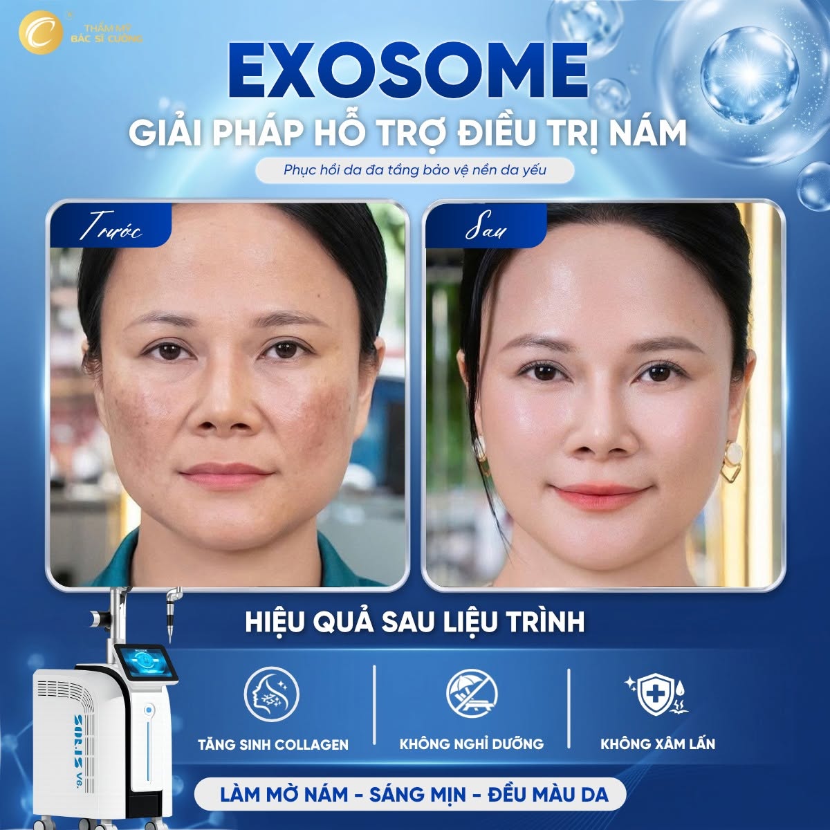 Exosome - Giải pháp hỗ trợ điều trị nám
