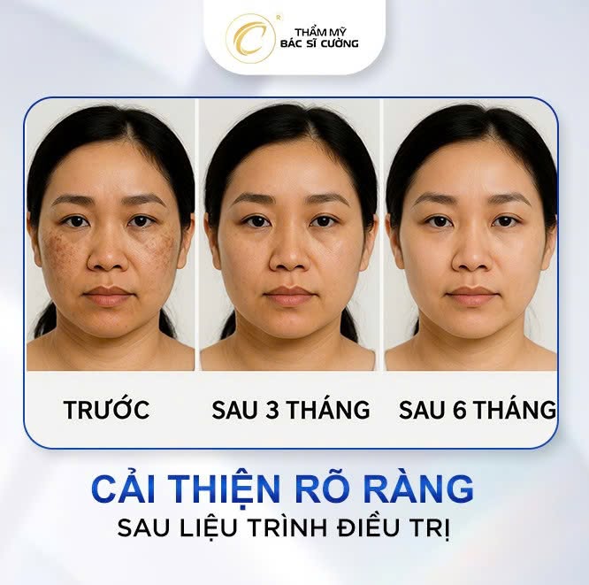 Khách hàng điều trị nám tại Thẩm mỹ BS Cường