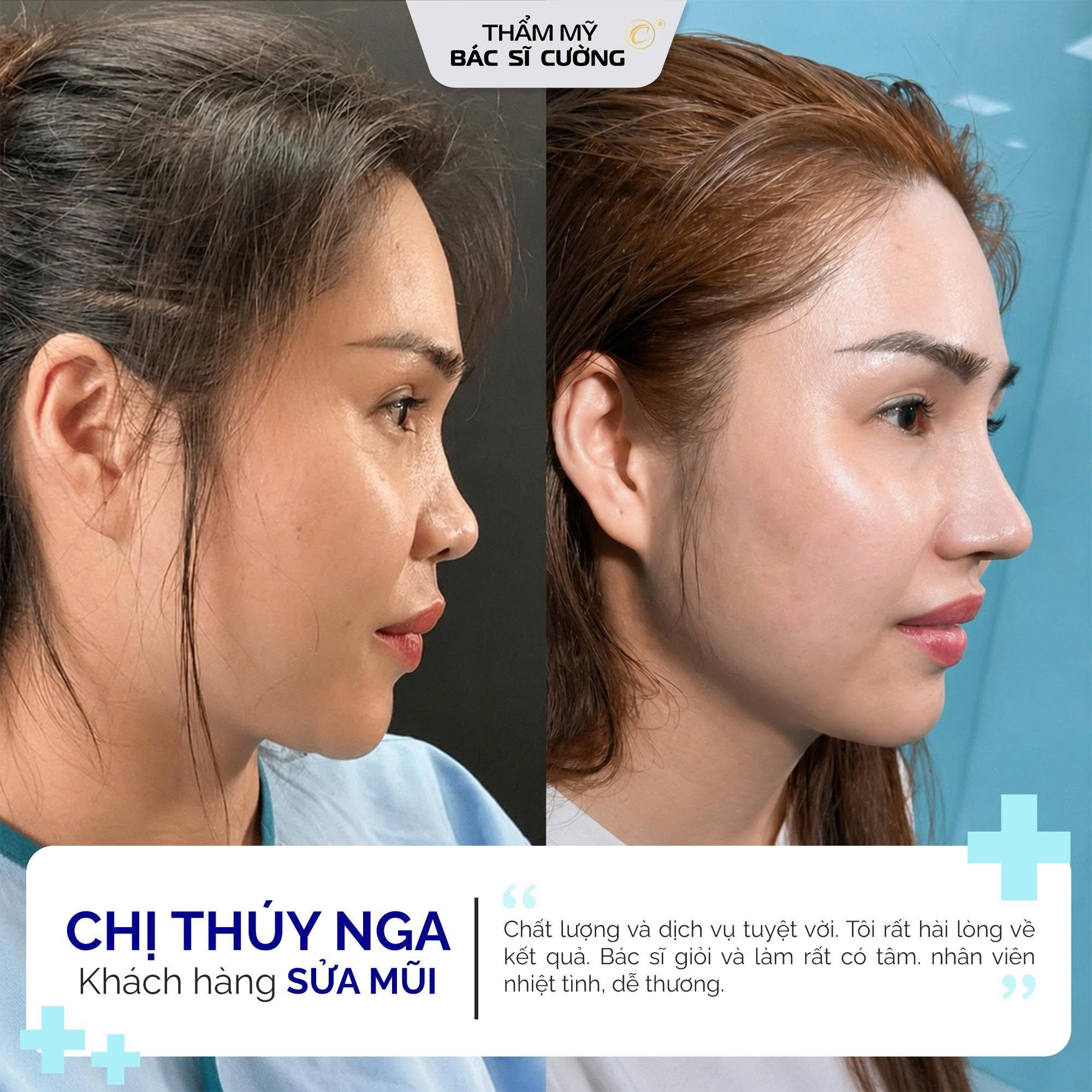 Cảm nhận của khách hàng sau khi nâng mũi tại Thẩm mỹ BS Cường