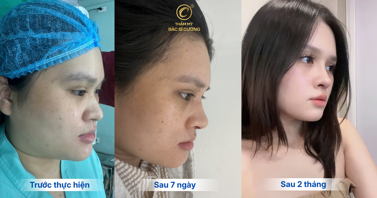 Nâng mũi bao lâu thì ổn định?