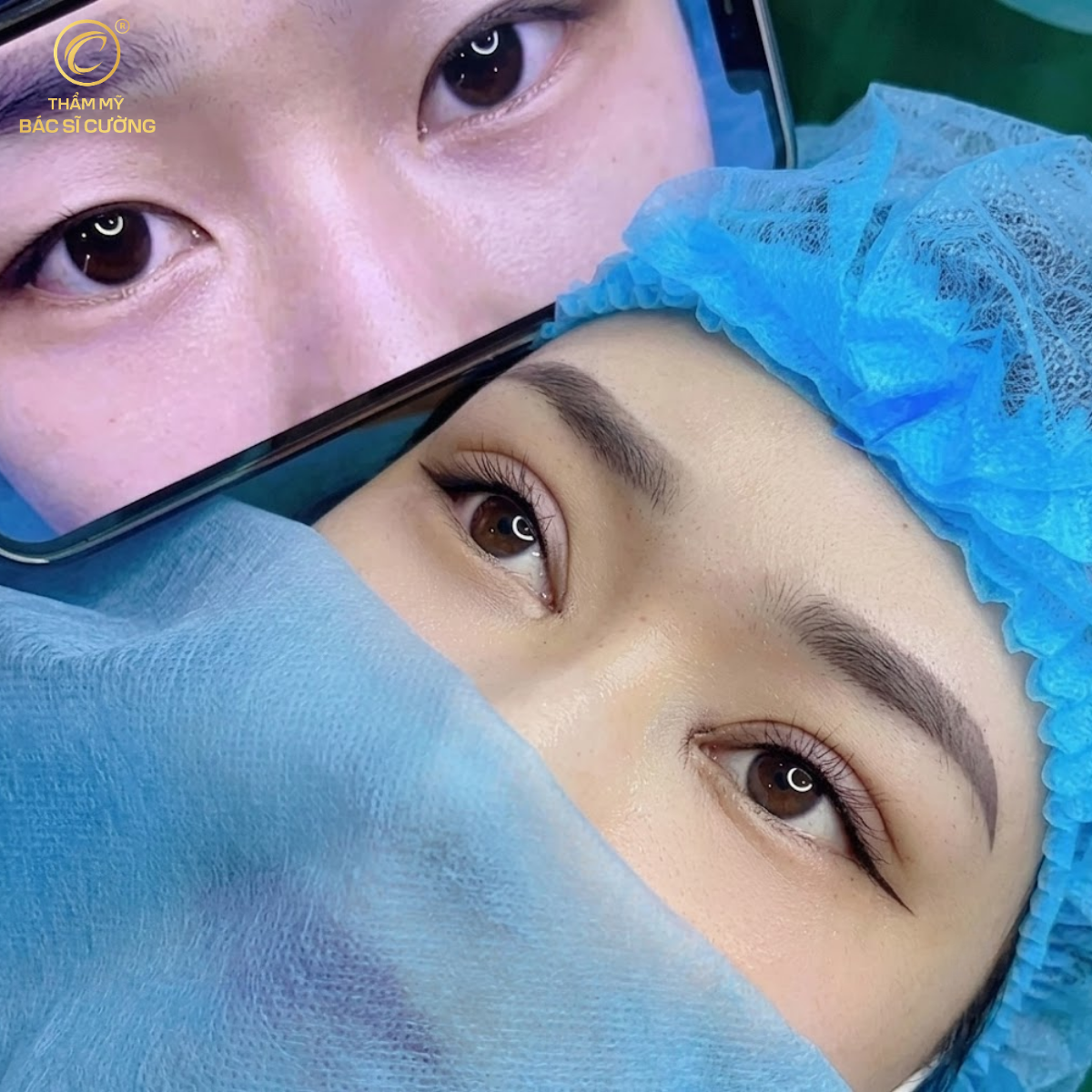 Lấy mỡ bọng mí dưới