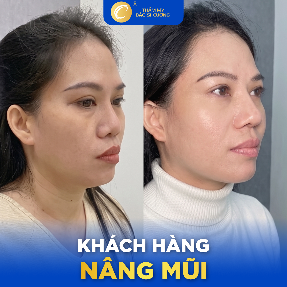 Yếu tố quyết định kết quả nâng mũi sụn tự thân hay sụn nhân tạo