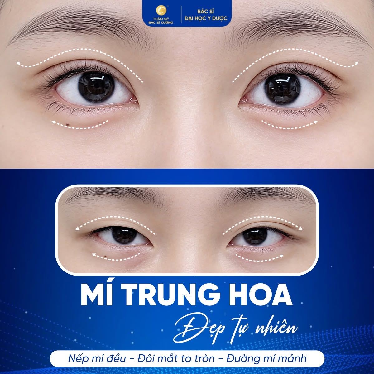 Cắt mí Trung Hoa