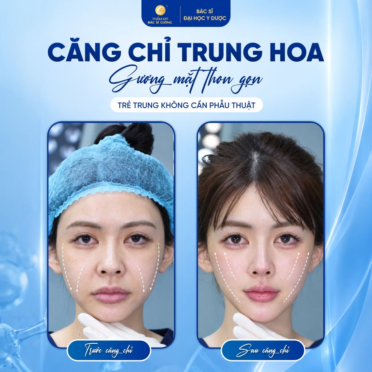 Căng chỉ Trung Hoa
