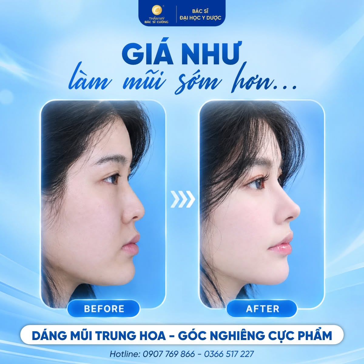 Dáng mũi Trung Hoa