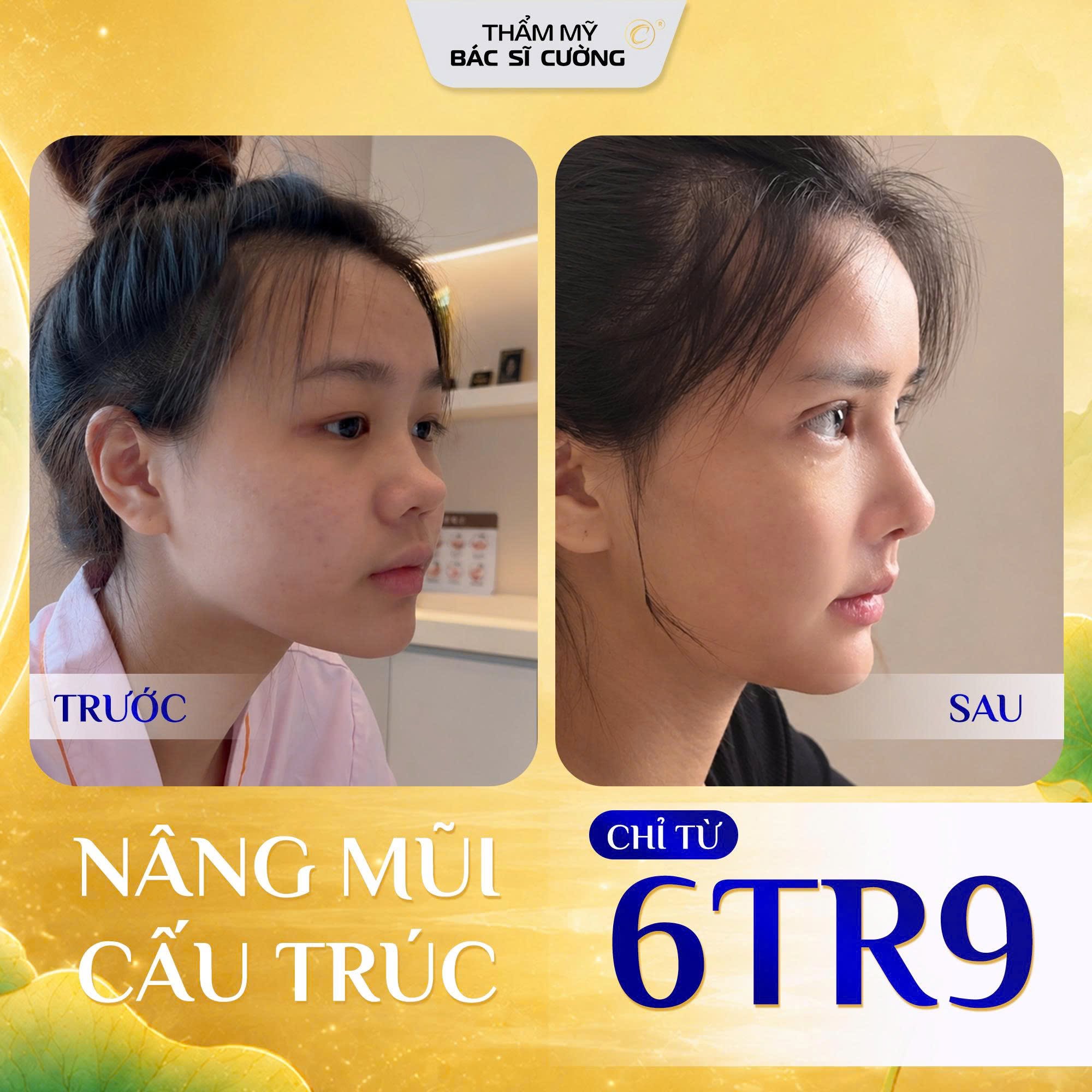 Dịch vụ nâng mũi tại Thẩm mỹ BS Cường