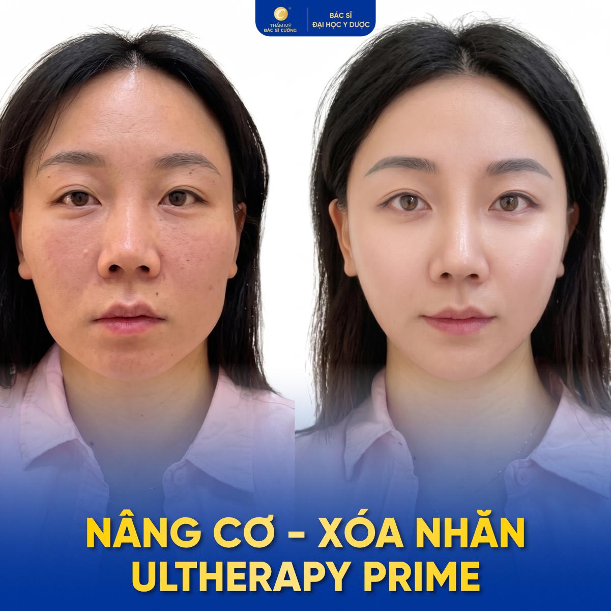 Khách hàng Thẩm mỹ BS Cường trải nghiệm Ultherapy Prime 