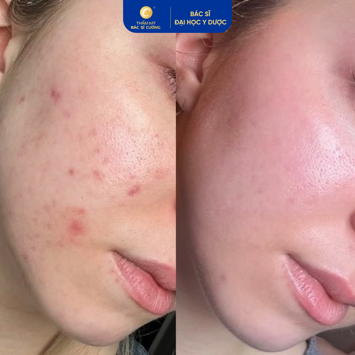 Công nghệ Laser CO2 Fractional hỗ trợ cải thiện sẹo rỗ và sẹo mụn