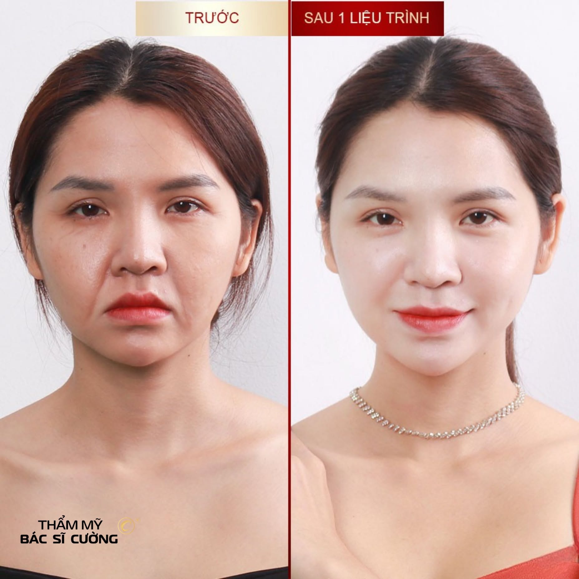 căng da mặt bằng chỉ tại Thẩm mỹ Bác sĩ Cường