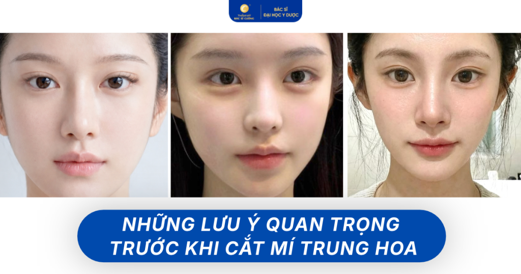 những lưu ý trước khi cắt mí Trung Hoa