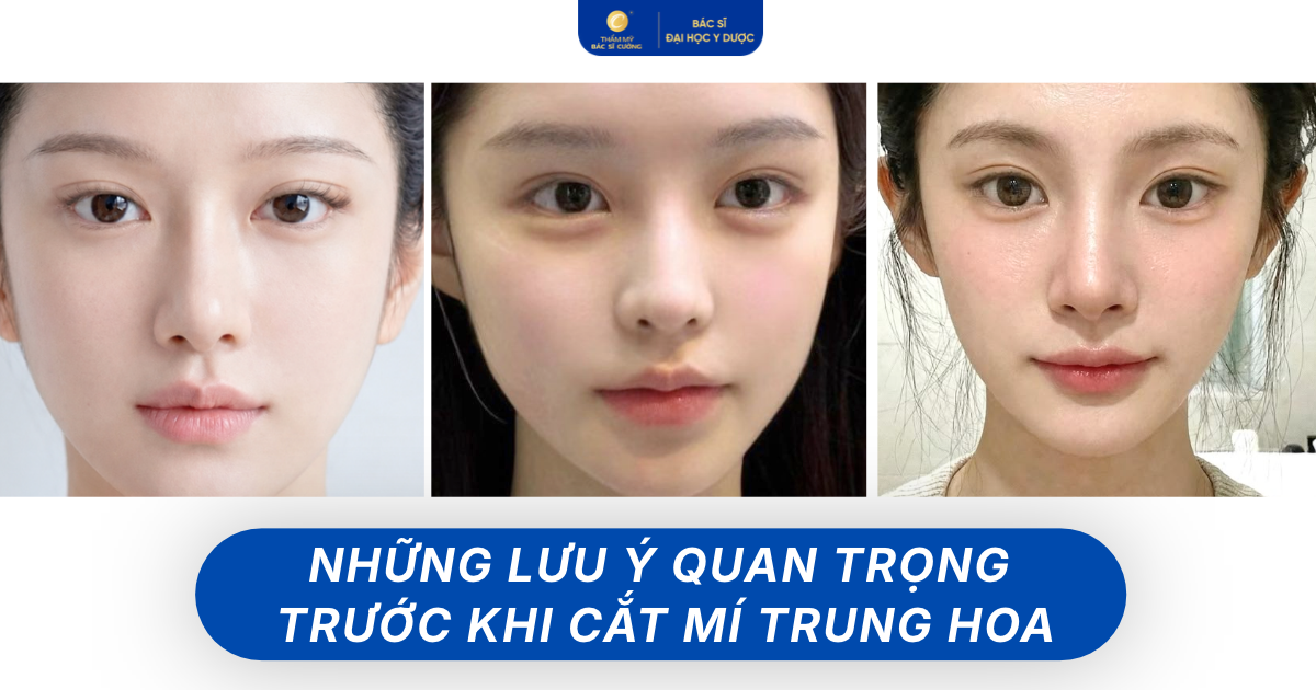những lưu ý trước khi cắt mí Trung Hoa