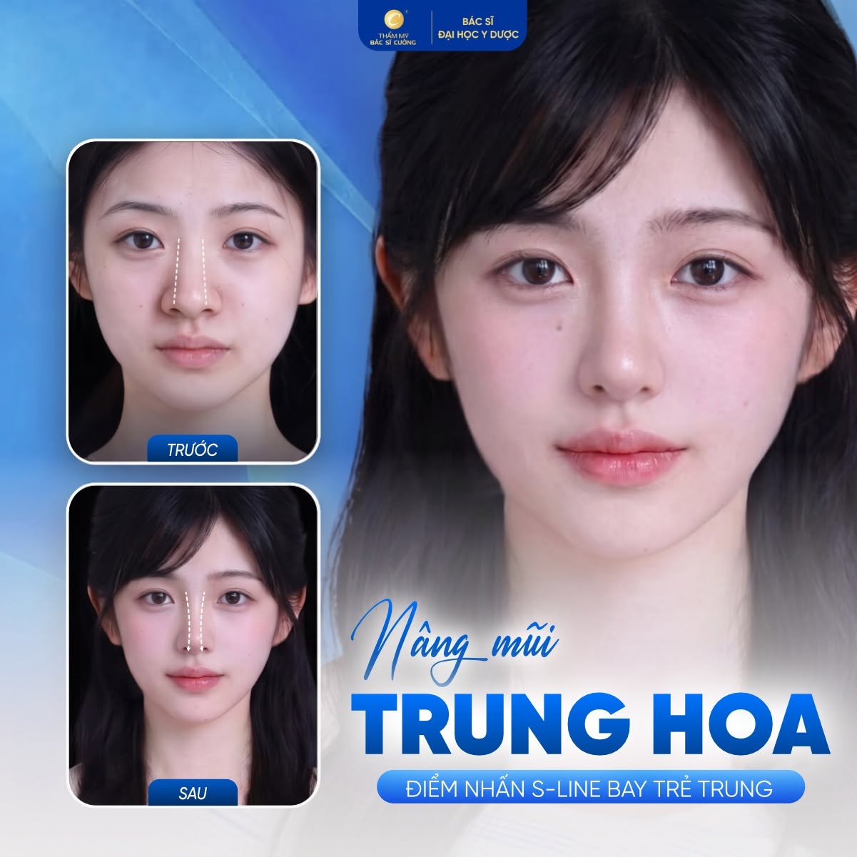 nâng mũi Trung Hoa an toàn, không sẹo tại Thẩm mỹ Bác sĩ Cường