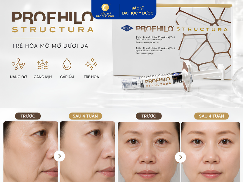 ưu điểm tiêm profhilo